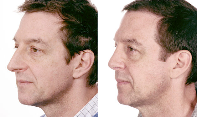 Nose Size Stephan Bessler Nasal Surgery Clinic Zurich nose size stephan bessler nasal